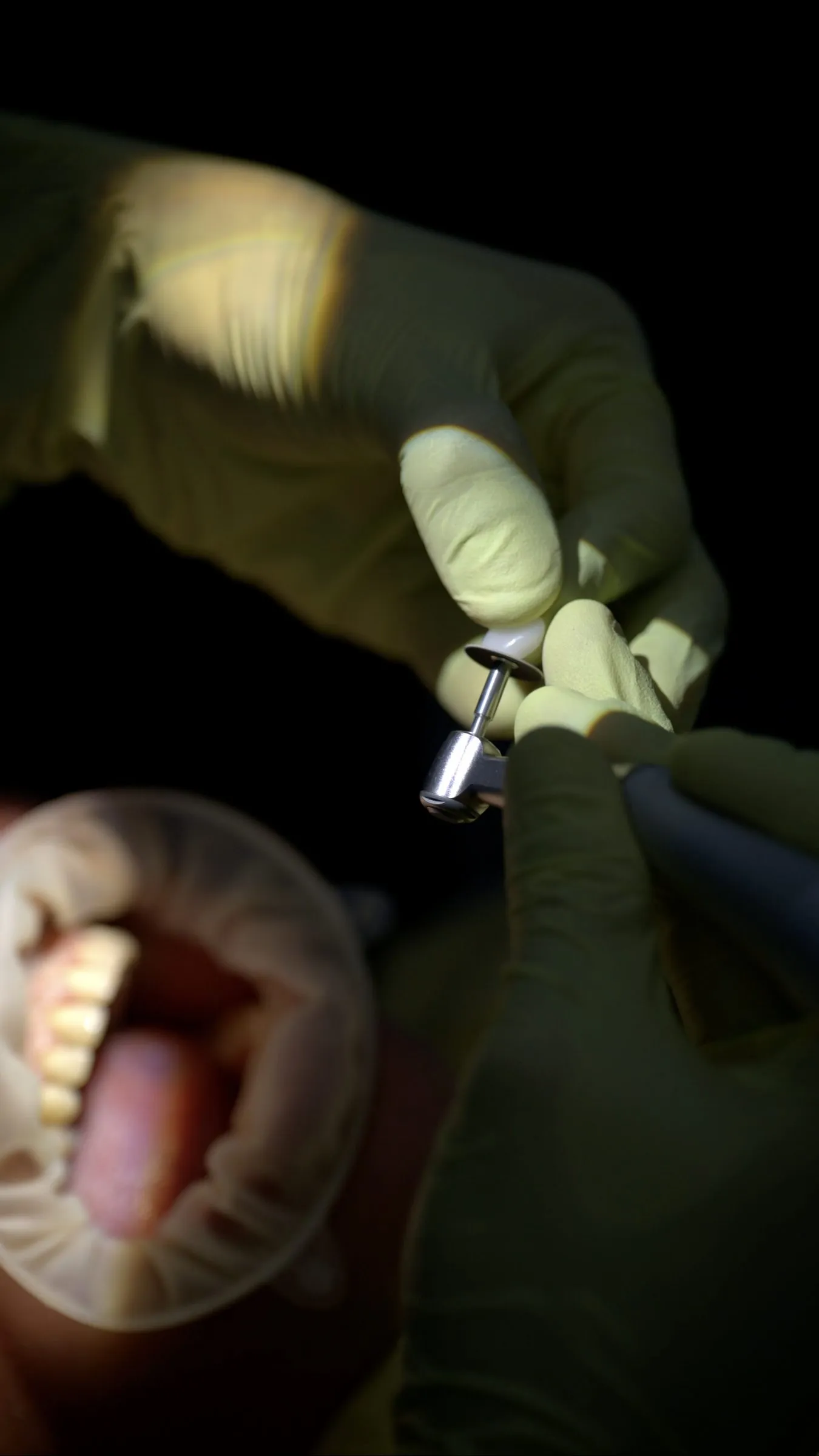 Procedimiento dental en acción, momento real capturado durante la consulta