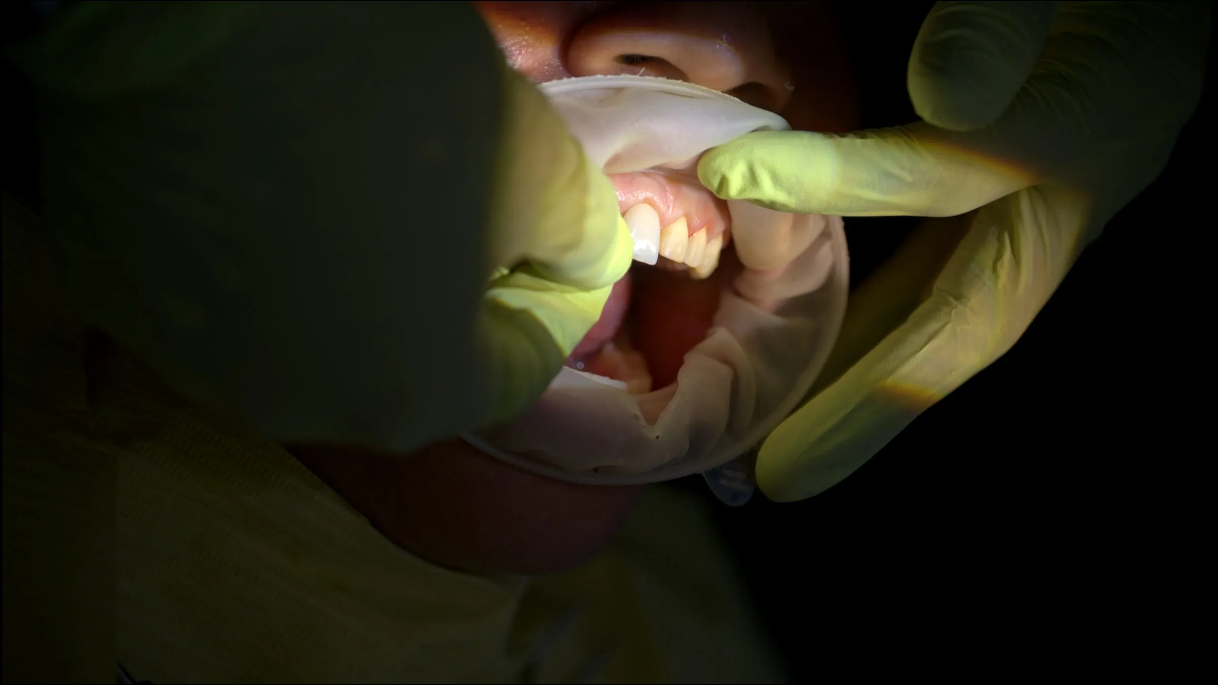 Primer plano de la boca de un paciente con separador bucal, mostrando los dientes superiores durante el procedimiento.