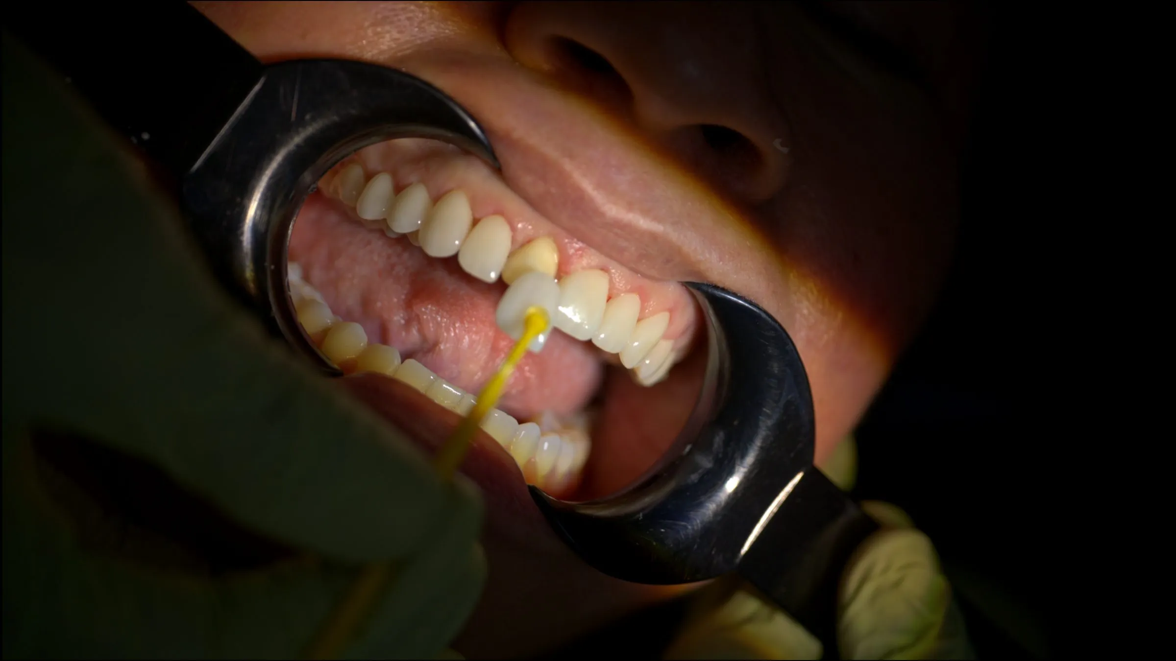 Primer plano extremo de una sonrisa sostenida con separadores metálicos, mientras se aplica una luz de fotocurado sobre un diente.
